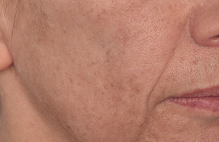 Vita-C_Glycolic_Serum_After_733x476_1