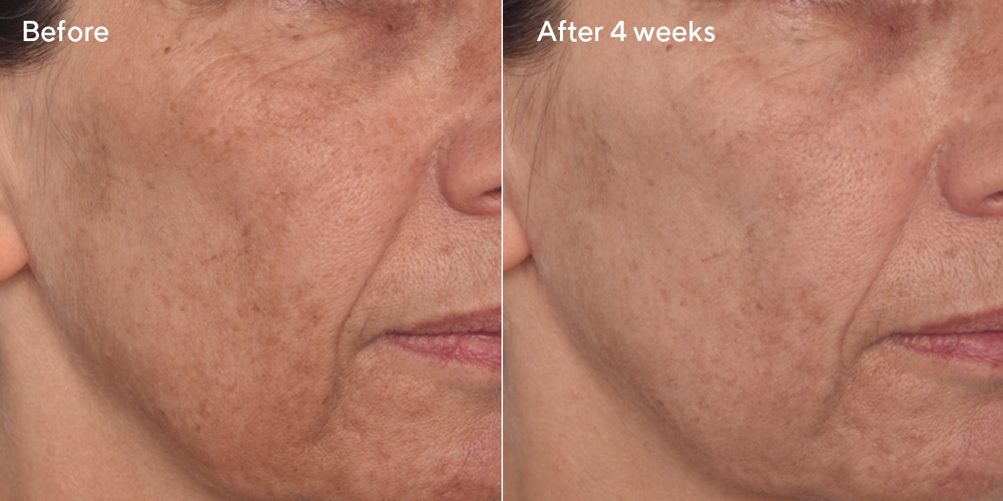 The Ultimate Guide to Reducing Dark Spots (With Dermatologist Tips)