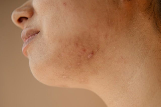 Menopause and Acne: Why Breakouts Happen in Your 30s & 50s and How to Treat Them