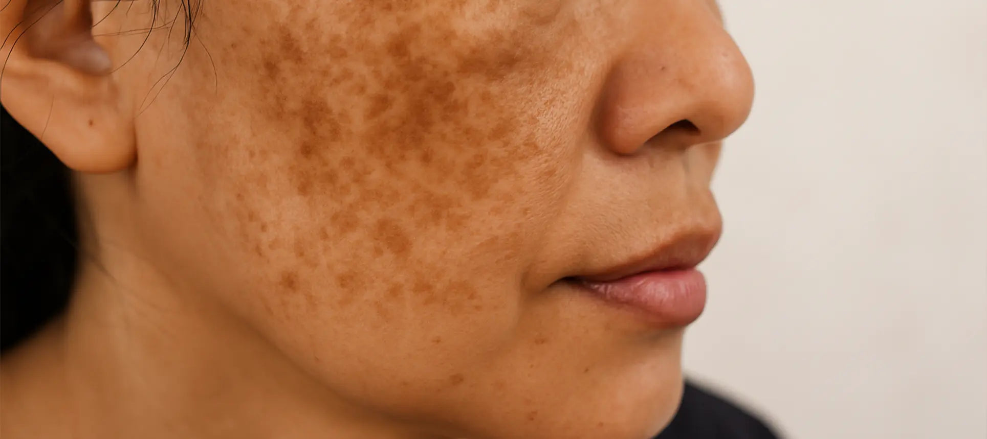 How to Remove Dark Spots - A Complete Dermatologist Guide