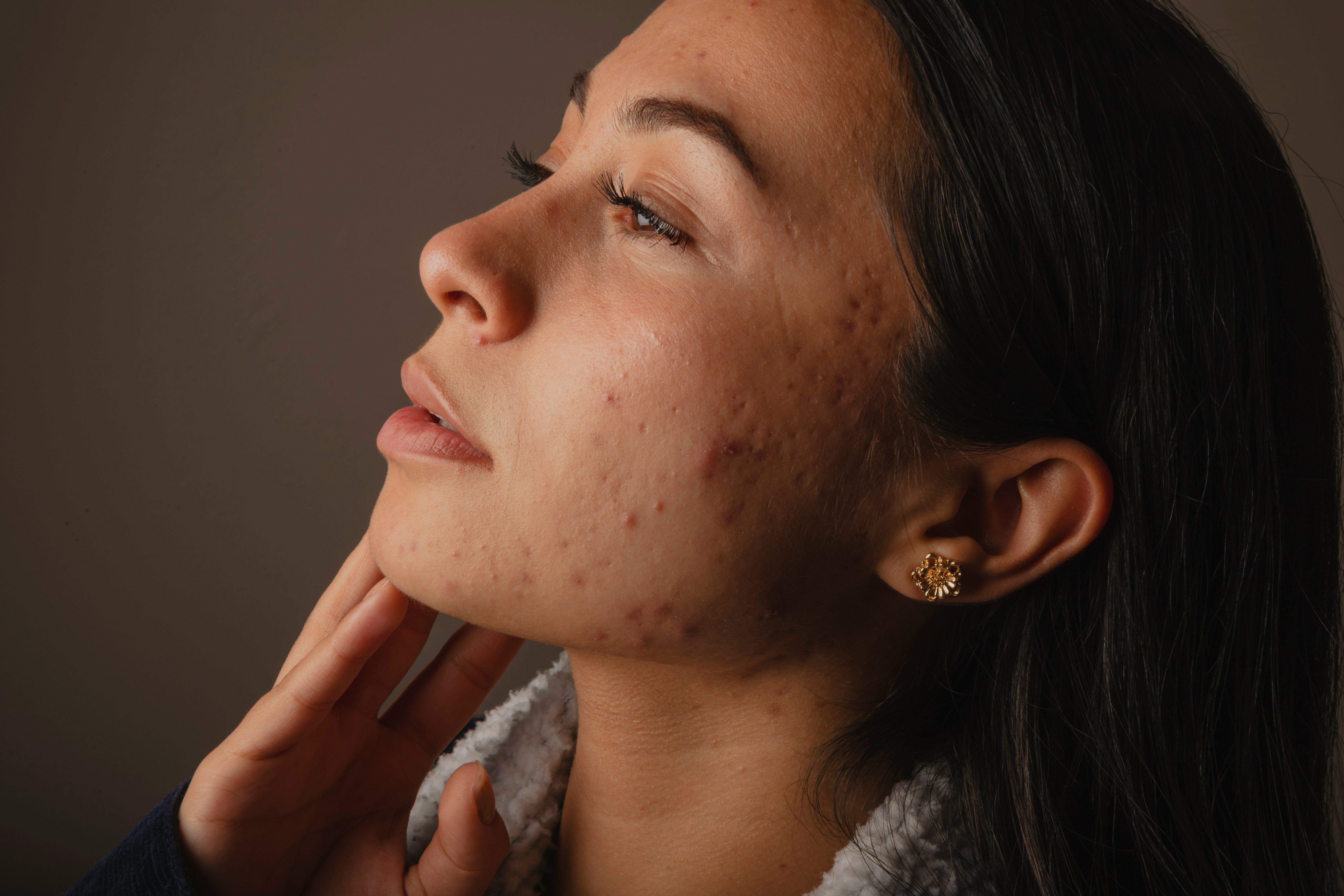 June Is Acne Awareness Month: Understanding Hormonal & Adult Acne During Perimenopause - and Murad’s Science-Backed Solutions