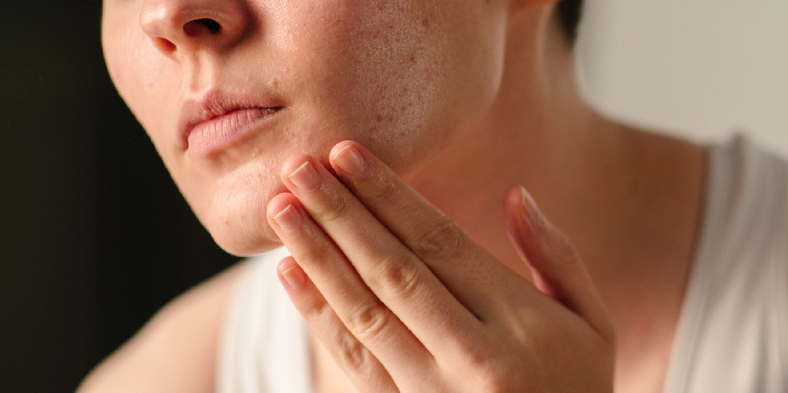 June is Acne Awareness Month: How Murad Skincare is Leading the Charge Against Breakouts