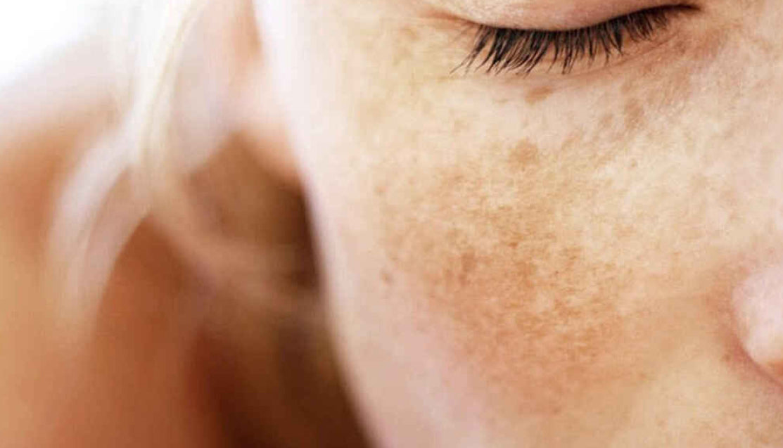 The Best Serums for Managing Melasma and Hyperpigmentation