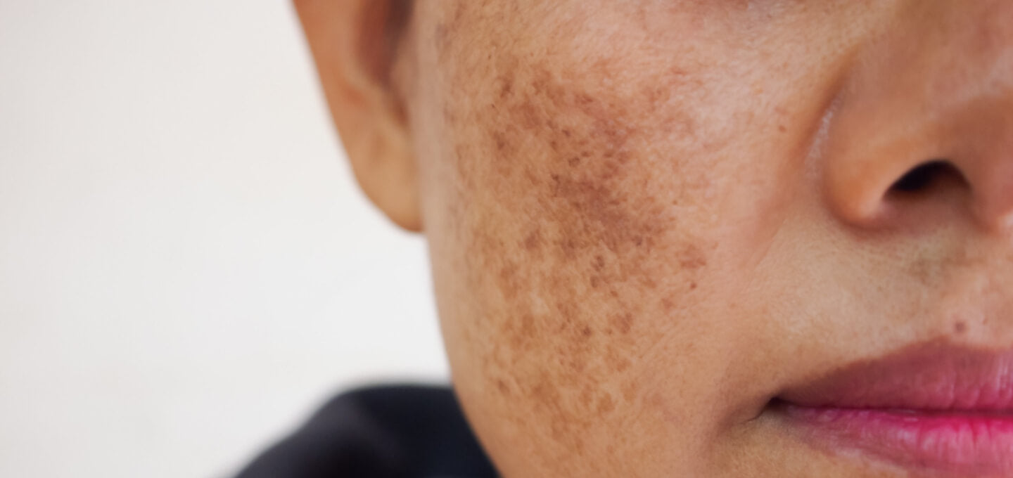 Melasma: Causes, Treatments, and Skincare Ingredients That Help