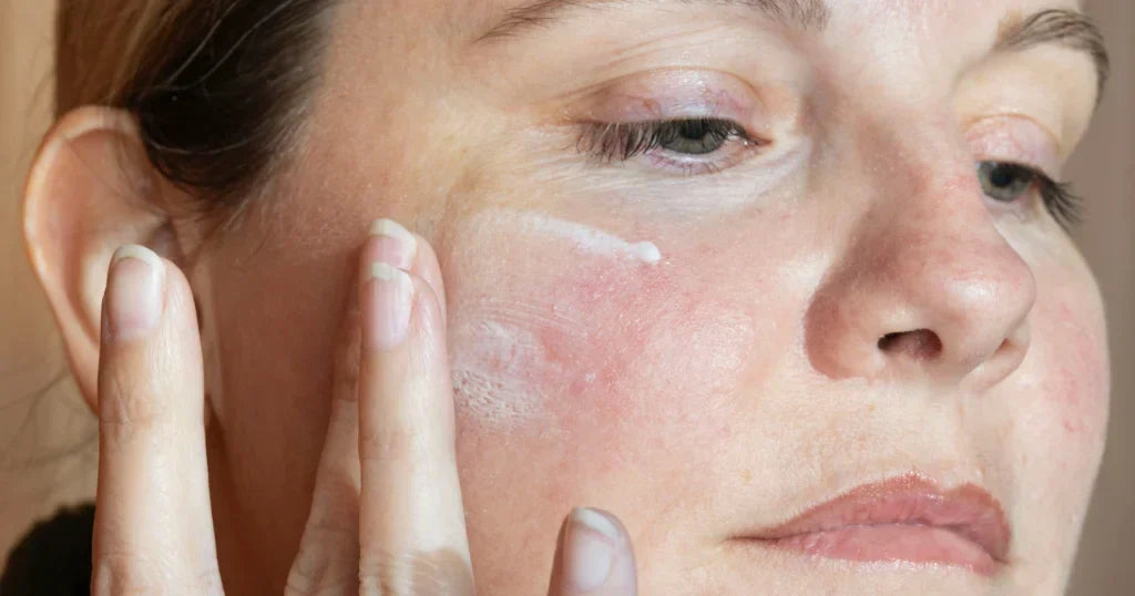 Top Tips for Managing Rosacea-Prone Skin