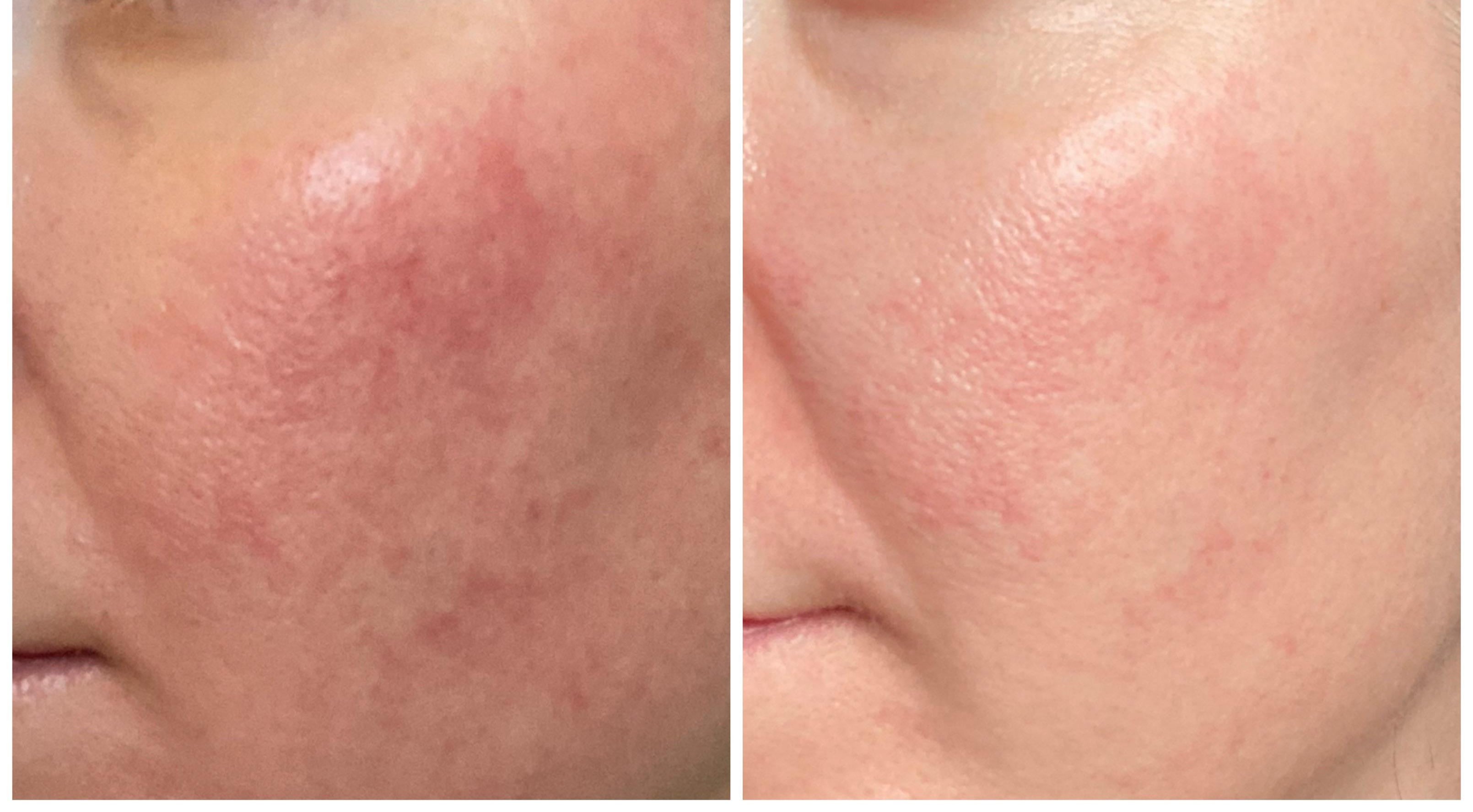 Professional Top Tips for Treating Skin with Rosacea