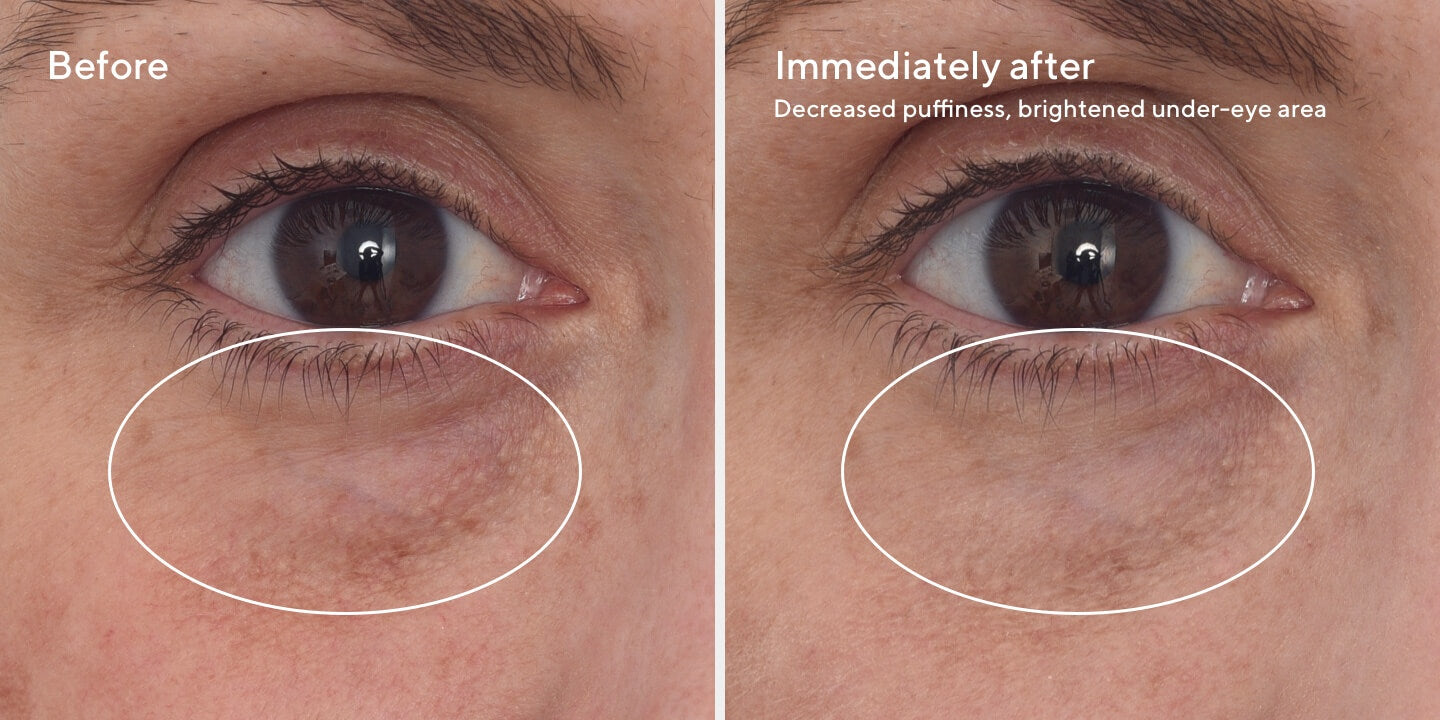 2023 Sept Targeted Eye Depuffer B&A 2