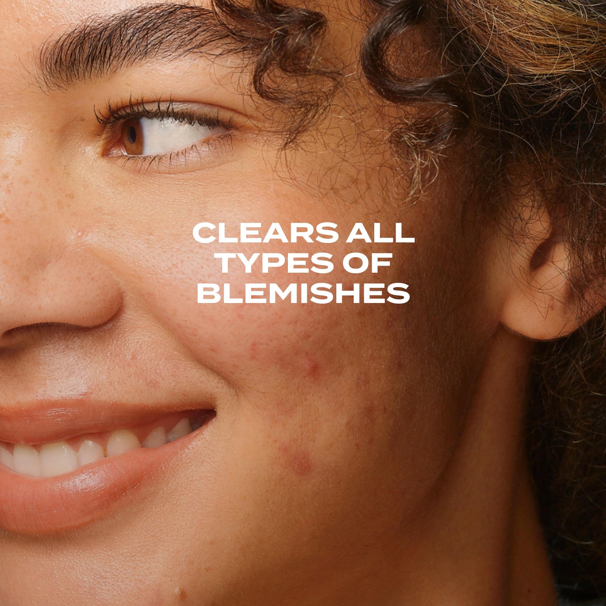 Biome-Balancing Clear & Prevent Blemish Treatment Serum