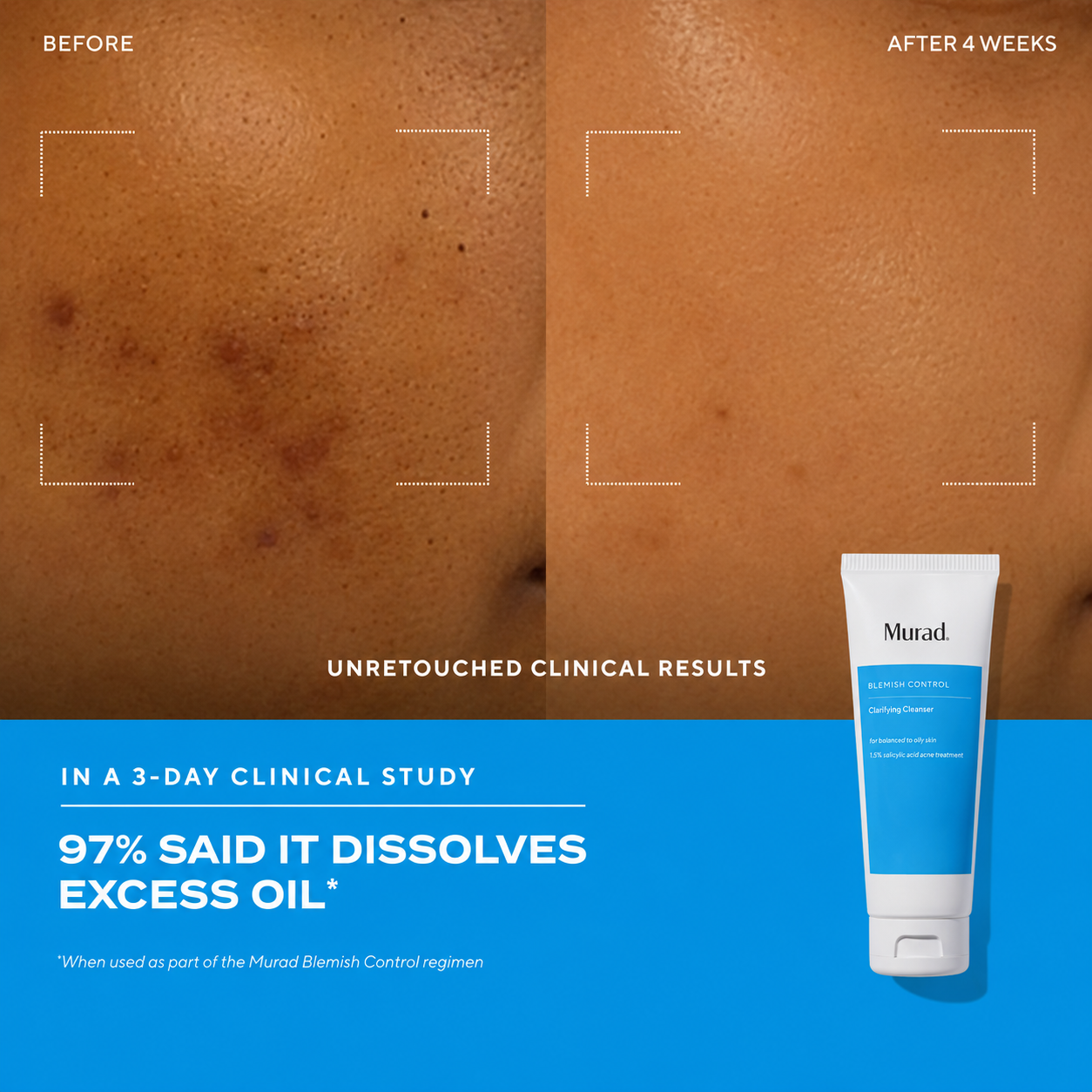Clarifying Cleanser Before and After