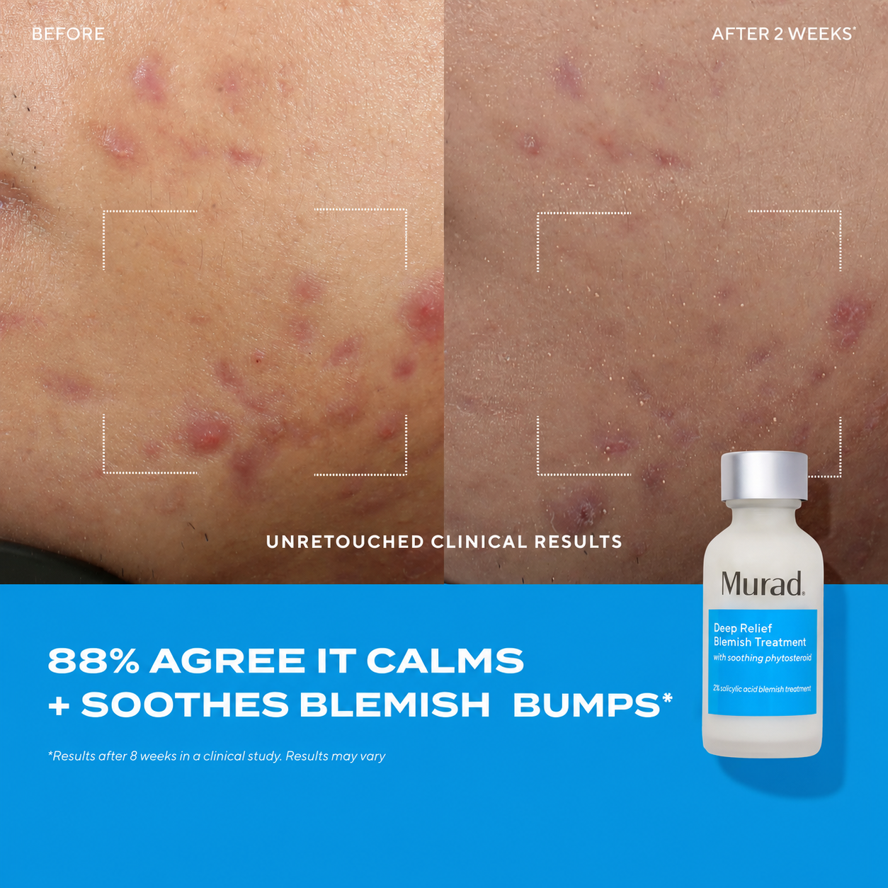 Deep Relief Blemish Treatment Before and After 1