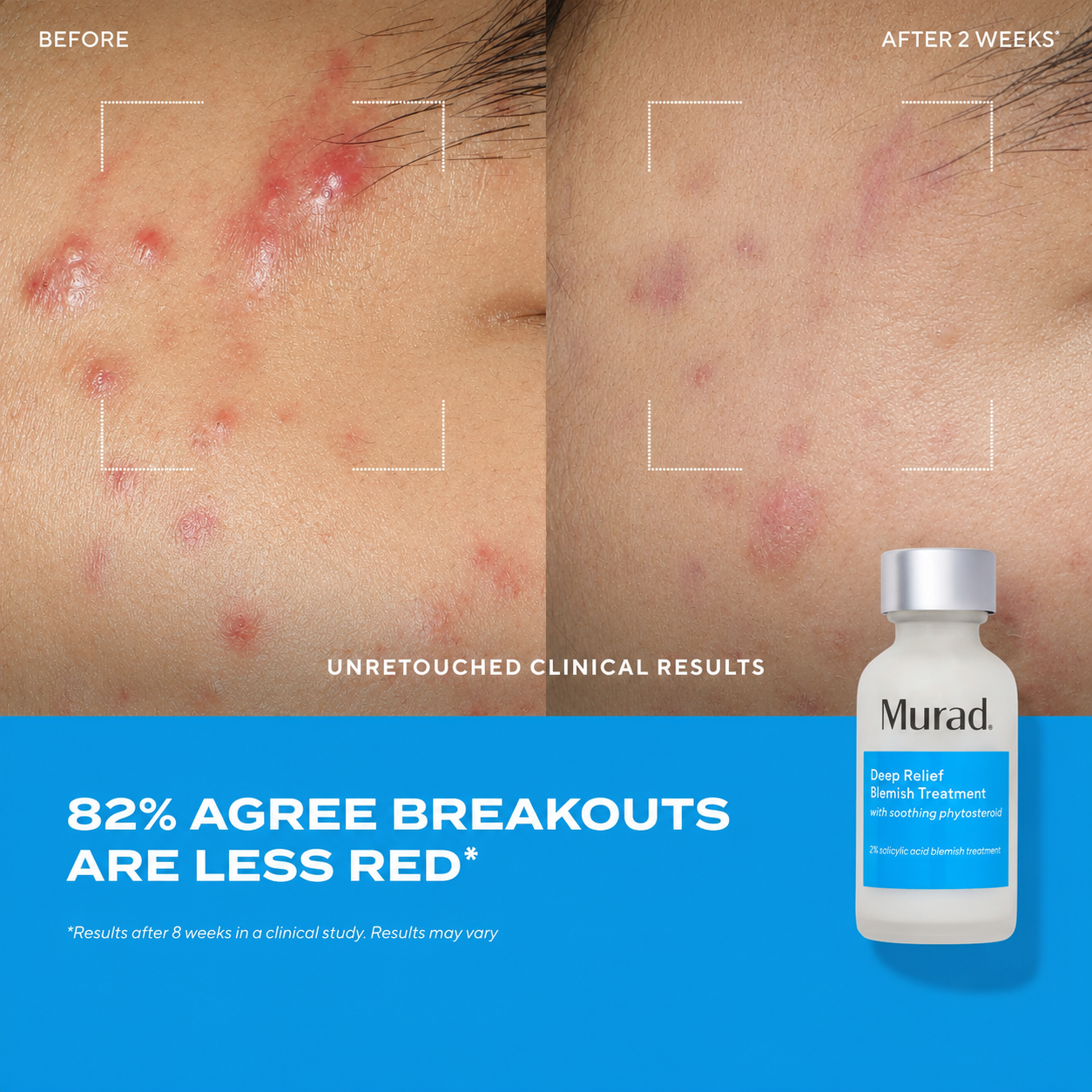 Deep Relief Blemish Treatment Before and After 2