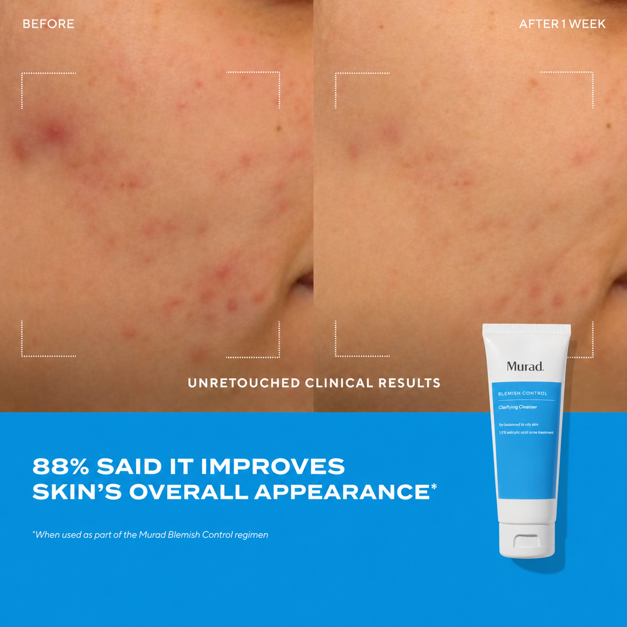 Clarifying Cleanser before and after 2