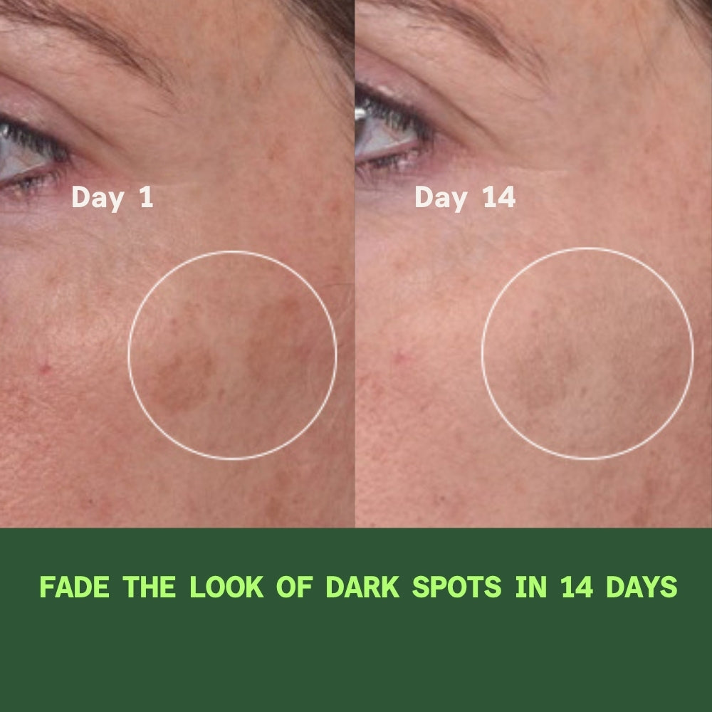 Before and after comparison of dark spots on skin with text indicating improvement over 14 days.