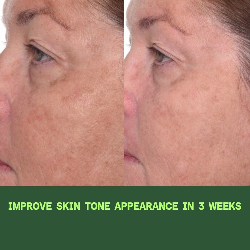 Before and after showing visible reduction in melasma and dark spots after 3 days