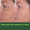 Before and after showing visible reduction in melasma and dark spots after 3 days