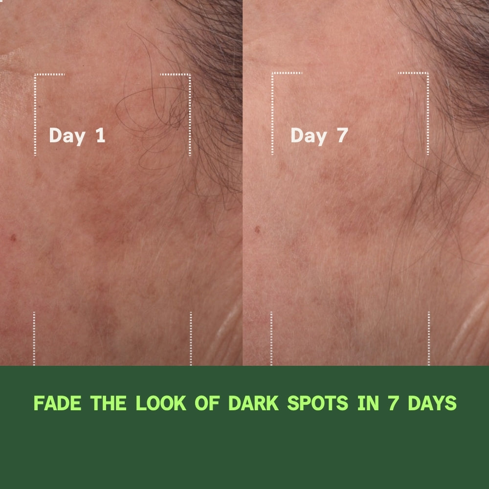 Before and after showing reduction in melasma and dark spots after 7 days