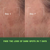 Before and after showing reduction in melasma and dark spots after 7 days
