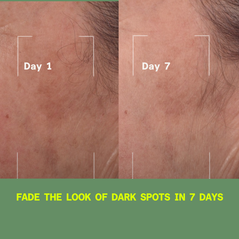 Before and after showing reduction in melasma and dark spots after 7 days