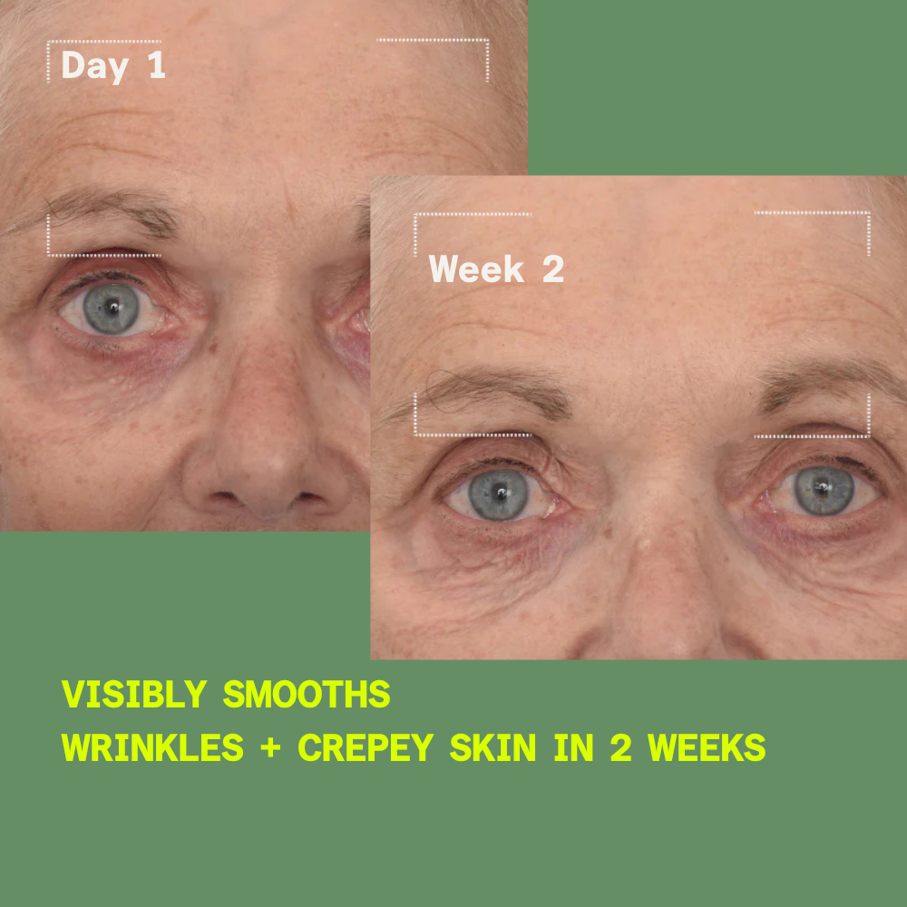 Before and after comparison of a person's eye area with text indicating skin improvement over 2 weeks.