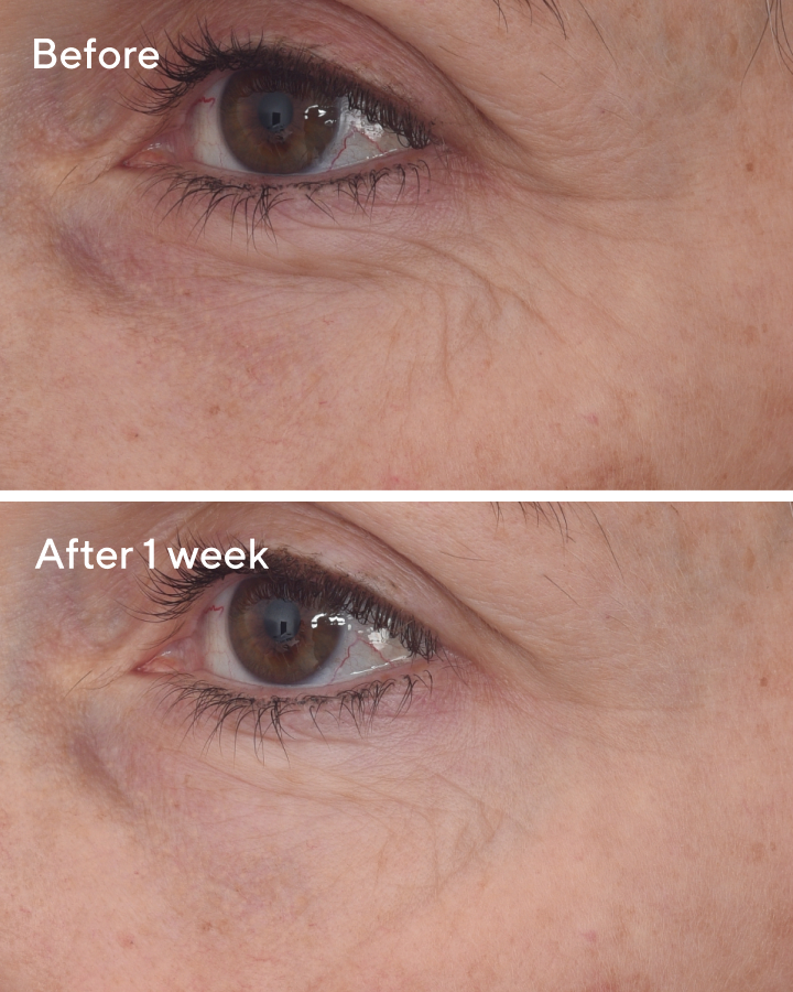 Retinal ReSculpt Eye Lift Treatment