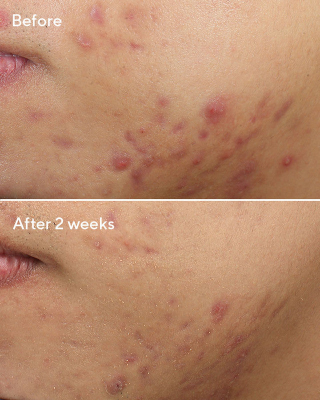 Deep Relief Blemish Treatment